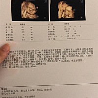 今天去做的四维，说胎儿右肾分离，只能再复查看看了，做个检查真是提心吊胆的