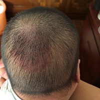 今天给宝宝剪头发突然发现后脑上面红的一块，有人知道这是怎么回事吗？宝宝吃喝拉撒都正常，好担心