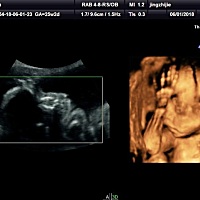 四维，医生说蓝色可能性比较大，是暗示男宝吗？25周，有可能翻盘不，祈祷