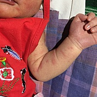 湿疹吗？怎么治疗？大神们？