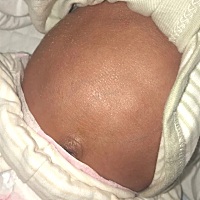 宝宝从出生第十一天开始肠胀气，腹部可见明显青筋，去浙江大学附属儿童医院检查治疗过，检查结果都是好...