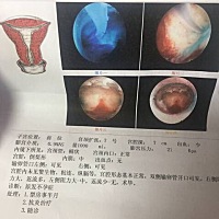 输卵管堵塞！一年未育！受尽折磨！终于可以实现了 我和我老公是相亲认识的，我们对对方的感觉都不错，彼...