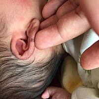 这个记还是痣？