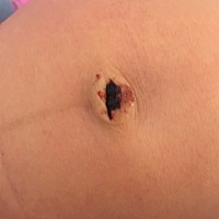 宝宝18天，肚脐好像破了，结痂了，怎么回事？用不用去医院看看？