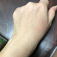 不知道是不是前天吃了点窄鸡排就长了一点点的红点，就手背跟肚子长，请问知道是什么问题吗？