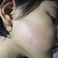 大家帮我看看，我宝宝皮肤这是怎么了，印象中从出生就不怎么好，一岁多总是长这样的疙瘩，大夫说就是湿...