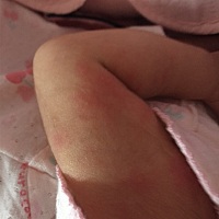 这是唔的太热，还是过敏了？