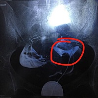 想问下，有没有鞍型子宫得姐妹们呢？我备孕一年，上个月检查出来是鞍型子宫，医生说这种子宫畸形做试管...