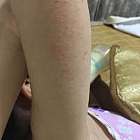 小孩手臂长好多小颗粒，不痛不痒，但是近期原来越多，这是什么情况，有什么药膏推荐，人家说这不是湿疹
