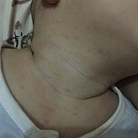 麻烦各位宝妈帮我看看这个是痱子吗？宝宝这几天才出现的，白天很热的时候才会有，都在头顶，耳朵，脖子...