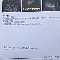 NT顺利通过。  检查费用970抽了好多血