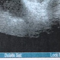 大家帮忙看一下胎囊是圆的还是长的啊