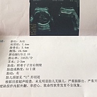 29 3    今天做B超脐带绕颈一周，希望宝宝自己转回来，上次检查体重大小偏小，今天检查正常了，真棒👍...