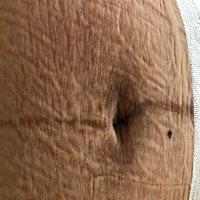 剖腹产四天，我的肚子。😭😭😭😭😭😭😭😭还有没有机会消除了？！