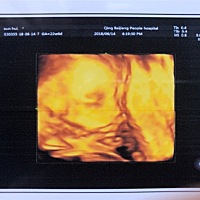 今天打了四维，折腾了一下午。打了三次终于照了个侧面，脐带绕颈2圈。想问一下宝宝这样生出来丑吗？