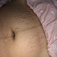 这妊娠纹 有什么方法 弄掉的吗 求介绍