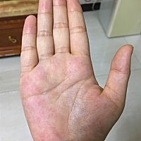 有没有宝妈和我一样，手心变成这样了。不知道这是怎么了，目前怀孕21周➕……