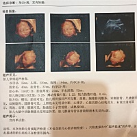 有宝妈帮忙看看吗？刚做三维回来，已经约不到医生看报告了～谢谢🙏