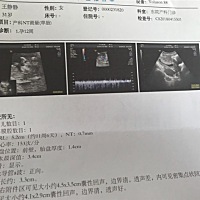 第一张是12周的时候B超 第二张是20+1 有谁会看一下是男是女吗