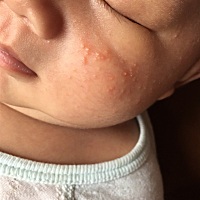 宝贝脸上湿疹怎么办有知道的姐妹吗