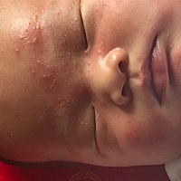 宝宝这几天长了很多这东西……那是越长越多……后脑勺的更大更白更多……比脸长得更可怕……很想去挤它...