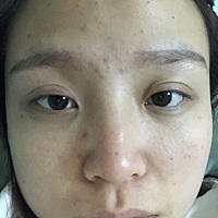 29周 这么多痘怎么办呀 孩子生了会好么？