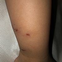 宝宝被蚊子咬过的地方很硬很肿怎么回事？有什么办法消肿吗？急急急