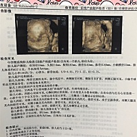 四维结果出来了，只有我一个人一眼就看出是宝宝脸了为啥大家都看不出来？宝爸说像个女娃娃，不管男孩女...