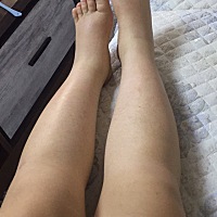 对比照……生之前水肿的腿脚，和生之后！生的时候170，现在142每天都在掉秤