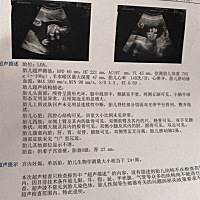 胎动大部分时间在左边动，上周去做了四维医生说指标正常，我就放心啦，两次没有照到宝宝正面不清晰，好...