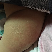 这两天宝宝不知怎么回事，脸上还有膝盖有很多红色的痘痘，有宝妈知道怎么回事吗？这是昨天拍的，昨天睡...