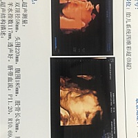 今天来做四维彩超，大家帮我看看是男宝还是女宝。