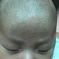 湿疹严重怎么办 😫😫😫