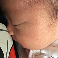 大家帮忙看看这个是痱子还是湿疹啊！有什么办法可以缓解啊！