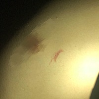 有没有小可爱帮帮忙鉴别一下这个是不是吻痕。在胸前。谢谢！