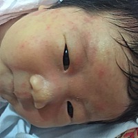 看看这是湿疹吗？