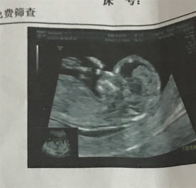 12周4天做的NT图