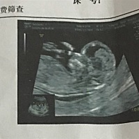 大家可以帮忙看男宝女宝吗？当妈的好像都很好奇、 12周4天做的NT图