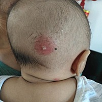 宝宝头上又长一个浓包！碰一下都痛的那种着急💩了，哪位亲知道要弄什么或者吃什么药才能缓解疼痛或者...