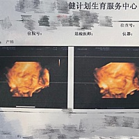 昨天做四维医生都说眼眶大眼睛大 长的好看的小北鼻😘