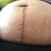 我是剖腹产 可以拆纱布后 自己鼓起勇气用镜子看了（老公不敢看）心里可怜自己  ！儿子是最大的安慰。