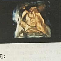 这是周一刚出来的大排畸照片，我自己是个大饼脸，所以很害怕会遗传宝宝，我看着照片中好想也是个大脸�...