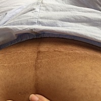 为什么怀孕到生肚子都干干净净的没长纹，生了之后肚子上很多皱皱皮，还黑黑的，会下去吗？