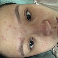 怀孕8个月了还涨这么多痘 怎么回事