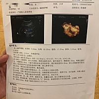 周一去做三维，宝宝一直不肯露脸，不配合，来回做了好几次都没成功！今天又换了一家医院做的五维，宝宝...