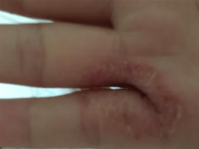 谁能告诉我这是长的啥？不痛不痒
