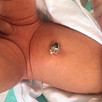 宝妈们，有没有出生11天肚脐还没脱落的宝宝呀，现在肚脐这样，一直还包着肚脐贴呢，