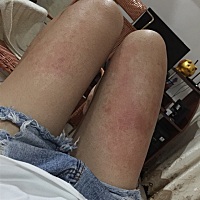 这生无可恋的脚，我该怎么办？？？？。。。。红肿痒！！