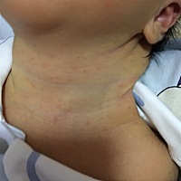 有没有宝妈知道这些红点是什么。是不是湿疹