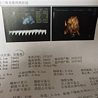 今天刚做的三维B超，感觉宝宝鼻子好大啊，哈哈